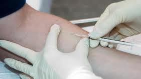 Tuberculosis Skin Test